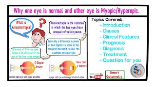 Why one eye is normal and other is Myopic or Hyperopic Simple Anisometropia [upl. by Araed]