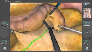 Sigmoidectomy 18 Peritoneal Incision on Simbionix LAP Mentor [upl. by Tdnarb661]