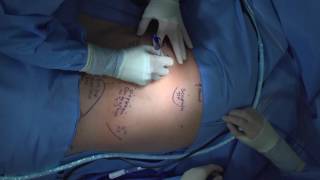 Technique for Chest Tube Insertion [upl. by Esinereb723]