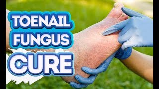 How to Cure Toenail Fungus Fast 3 BestEver Strategies [upl. by Lybis]