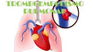 CÓMO SE PRODUCE LA TROMBOEMBOLIA PULMONAR [upl. by Latsyrhk]