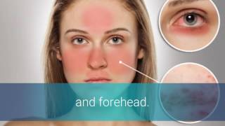 Rosacea Types [upl. by Lester]