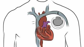 Difference Between Cardioversion and Defibrillation [upl. by Notniuq]