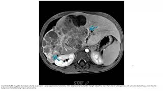 Hepatocellular Carcinoma Imaging [upl. by Okuy]