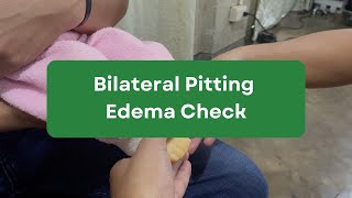 Bilateral Pitting Edema Check [upl. by Laing]