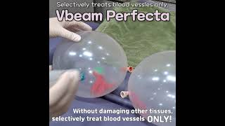 🎈VBEAM PERFECTA Balloon Laser Test [upl. by Annahahs]