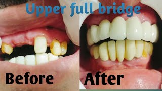 dental upper full bridge [upl. by Bautram]