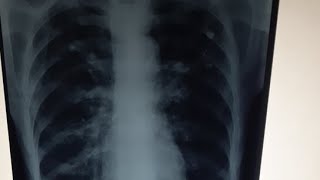 COPD CHEST X RAY EXPLAINED IN 2 MINUTES [upl. by Donohue]