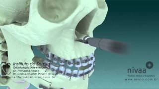 Cirurgia Ortognática Bimaxilar [upl. by Vocaay]