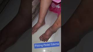 Pitting Pedam Edema Pedal Edema Pittingedema legswelling [upl. by Chapman]