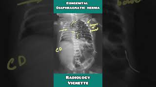 Congenital diaphragmatic Hernia on chest Xray explained for USMLE NEET PG INICET NCLEX [upl. by Ellerad]