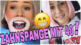 FESTE ZAHNSPANGE EINSETZEN😰 ABLAUF BRACKETS KLEBEN amp BEHANDLUNG  METALL oder KERAMIK [upl. by Nigam]