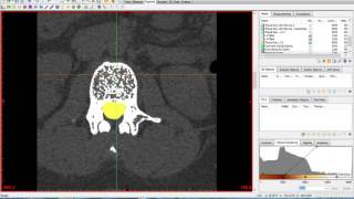 Materialise Mimics and 3Matic Tutorial [upl. by Oiromed34]