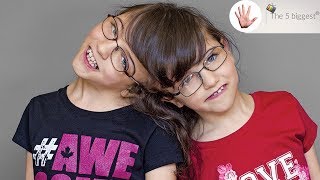 Do conjoined twins share thoughts Unbelievable facts  Body Bizarre [upl. by Zabrine996]