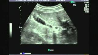 adenomyomatosisvideo1bmpg [upl. by Marelda]