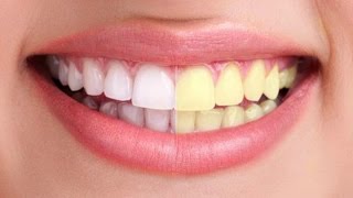 DIENTES BLANCOS CON VINAGRE  REMEDIO CASERO  RAPIDO Y ECONOMICO  CINDYLIMON [upl. by Analeh]