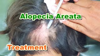 Alopecia Areata Treatment by ILS Intralesional Steroid Injections  Triamcinolone Acetonide [upl. by Annig869]