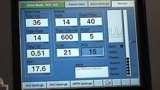 Respironics Esprit Ventilator with Blom Tracheostomy Tube [upl. by Nosahc]