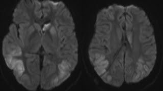 Case discussion Transient PostIctal MRI changes [upl. by Traci]