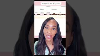 HOW TO REDUCE ACNE SCARS [upl. by Siobhan406]