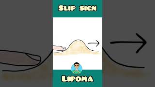 Slip sign in Lipoma  Surgery  shorts [upl. by Anelegna]