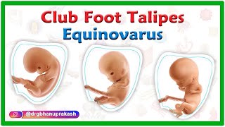 Club foot  Talipes equinovarus  Causes Symptoms Diagnosis and Treatment [upl. by Ujawernalo]