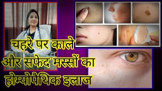 मस्सों का इलाज ll Warts On Face ll Best Treatment Of Face Warts ll Dr Anisha Kaushik [upl. by Emmalee]