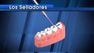 Selladores Dentales para los Adultos [upl. by Eloisa]