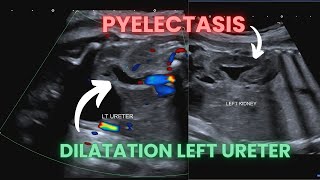 Ultrasound Pregnancy fetal pyelectasis and dilatated ureter Diagnosis criteria [upl. by Aratak307]