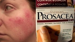 Prosacea Rosacea Treatment Product Review not sponsored  Rosy JulieBC [upl. by Wojak]