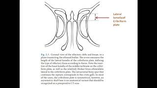 lateral lamella of cribriform plate [upl. by Rexanne]