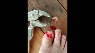 Big Toenail Removal with Vice Grips [upl. by Cressi]