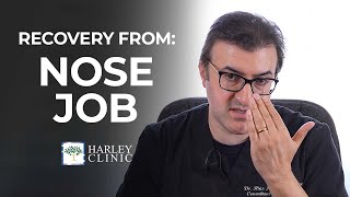 How Long Does Recovery Take For A Nose Job  Rhinoplasty Surgery Recovery Guide [upl. by Shamrao]