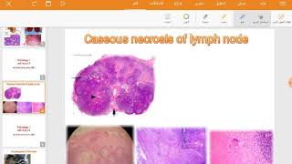 Caseous necrosis of LN example on irreversible cell injury [upl. by Anyar]