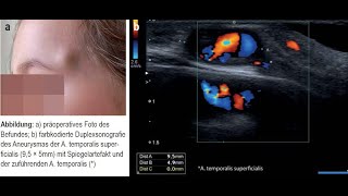 Traumatisches Aneurysma der A temporalis superficialis bei einem 4 jährigen Kind [upl. by Eedak81]