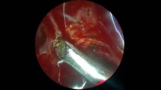 Anterior ethmoidal artery leak by prof dr jaskaran singh [upl. by Starlene]