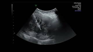 Ultrasound guided microwave ablation for uterine myoma [upl. by Geithner]