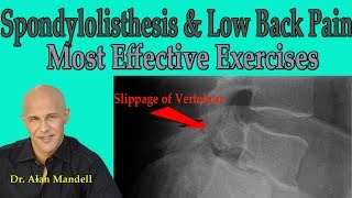 Spondylolisthesis and Low Back Pain Most Effective Exercises  Dr Mandell [upl. by Ainez]