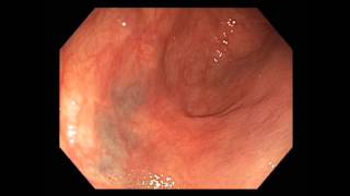 Colonoscopy Melanosis masquerading as cancer [upl. by Aerdnaeel]