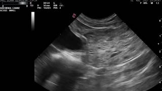 Benign prostatic hyperplasia and intraprostatic cysts [upl. by Browne]