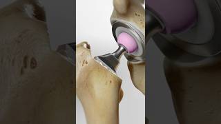 Total hip replacement explained 3D Animation [upl. by Nicky]