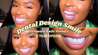 Dental Design Smile Miami Composite Veneers  ALL YOU NEED TO KNOW  Two Year Update [upl. by Dugaid]