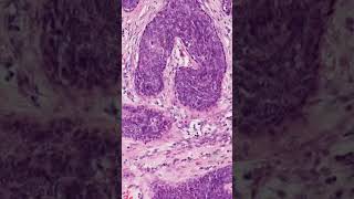 Nipple Adenoma Histology  Pathology shorts [upl. by Antonio]