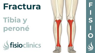 FRACTURA de TIBIA y PERONÉ Rehabilitación ejercicios y tiempo de recuperación FisioClinics Palma [upl. by Daney]