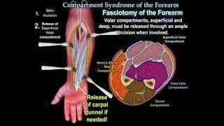 Compartment Syndrome Of The Forearm  Everything You Need To Know  Dr Nabil Ebraheim [upl. by Luann373]