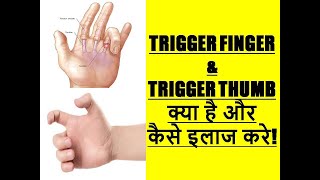 Trigger Finger Trigger Thumb Hindi ऊँगली अटकना अंगूठा अटकना  How to Treat Trigger Finger Fast [upl. by Gassman739]