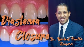 Diastema closure Composite restoration front teeth Dr Norbert Puello Reinoso [upl. by Ennaimaj416]