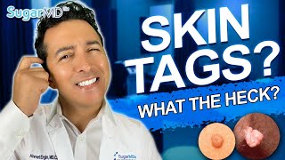 Skin Tags On Diabetics Are They Dangerous How to Get Rid of Them [upl. by Lonnie]