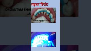 SPLINTING STOP TEETH MOBILITYdrgautam93 dentist teeth toothache [upl. by Ansel169]