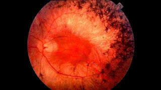 RETINITIS PIGMENTOSA LECTURE FULL EASY EXPLANATION DR SAIF ALI MEMON [upl. by Middle918]